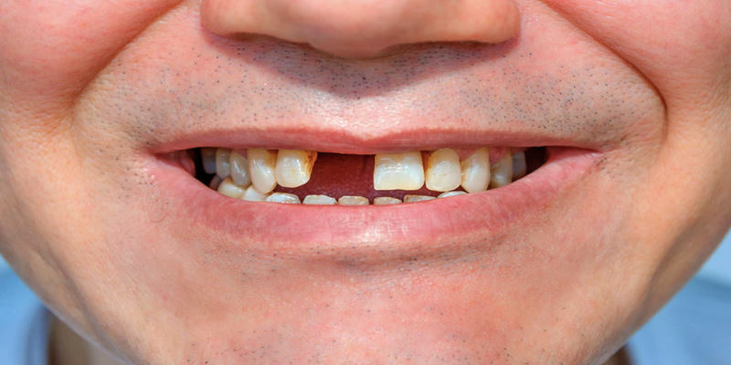 Ngủ mơ gãy răng đánh con gì chuẩn nhất?